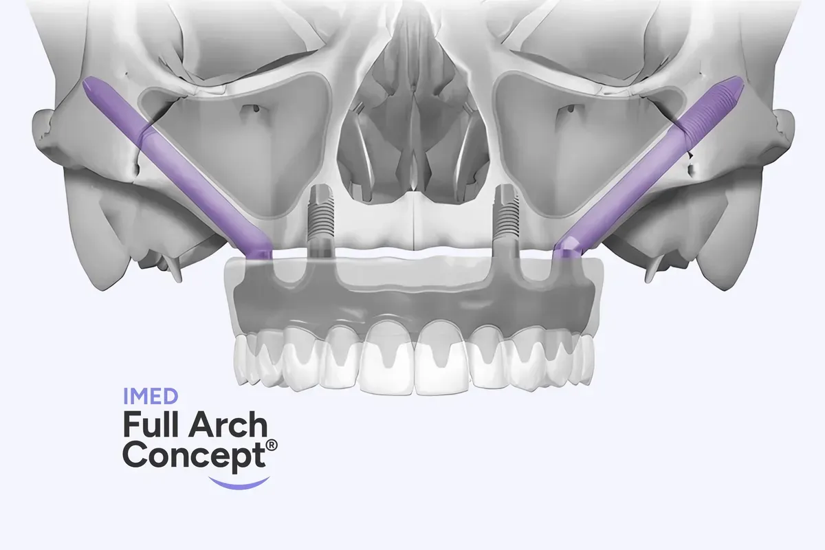 IMED Full Arch Concept® — najtežji slučajevi