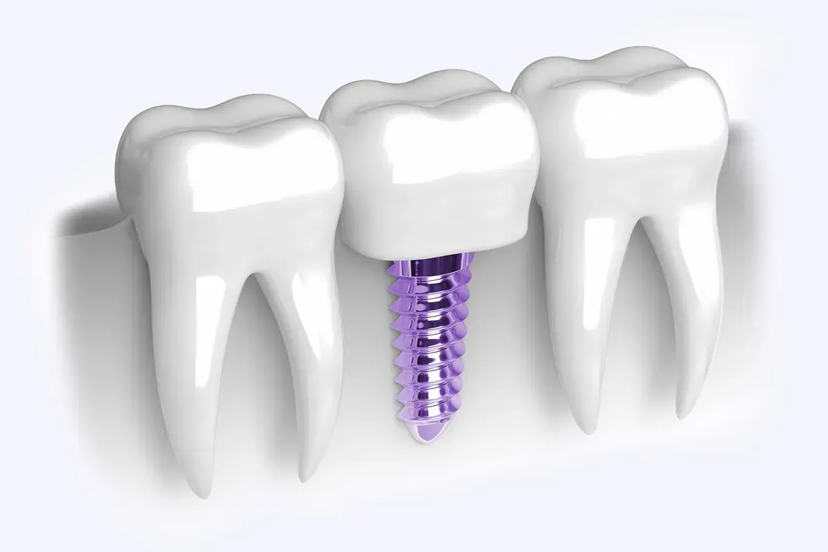 Implantati — jedan zub, most, nadoknada
